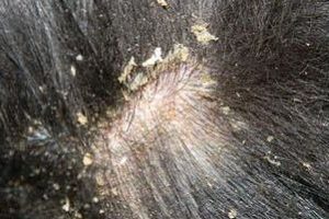 ➤ Síntomas de la Caspa en los Perros ¿Cómo detectarla?
