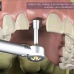 como se colocan los implantes dentales