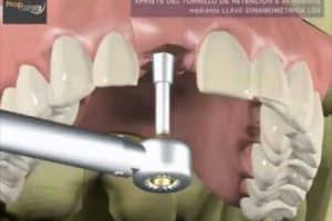 ¿Cómo Se Colocan Los Implantes Dentales?