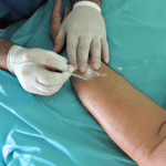 Como Cicatrizar Rapido Una Herida De Cirugia