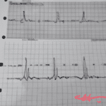 Cómo detectar un infarto en un electrocardiograma de manera efectiva.